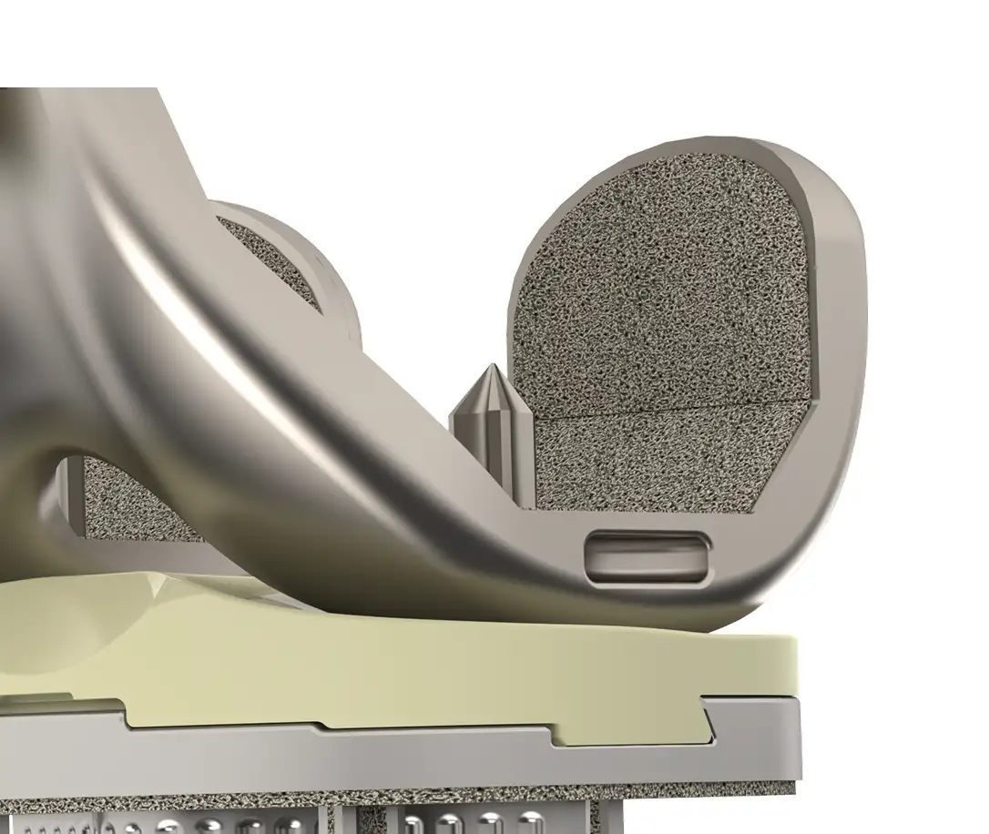 Close-up of the porous surface on the Optimotion cementless femoral component