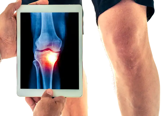 Patient reviewing a knee x-ray on a tablet