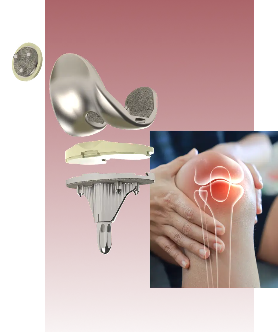 OI Blue Total Knee System implant components