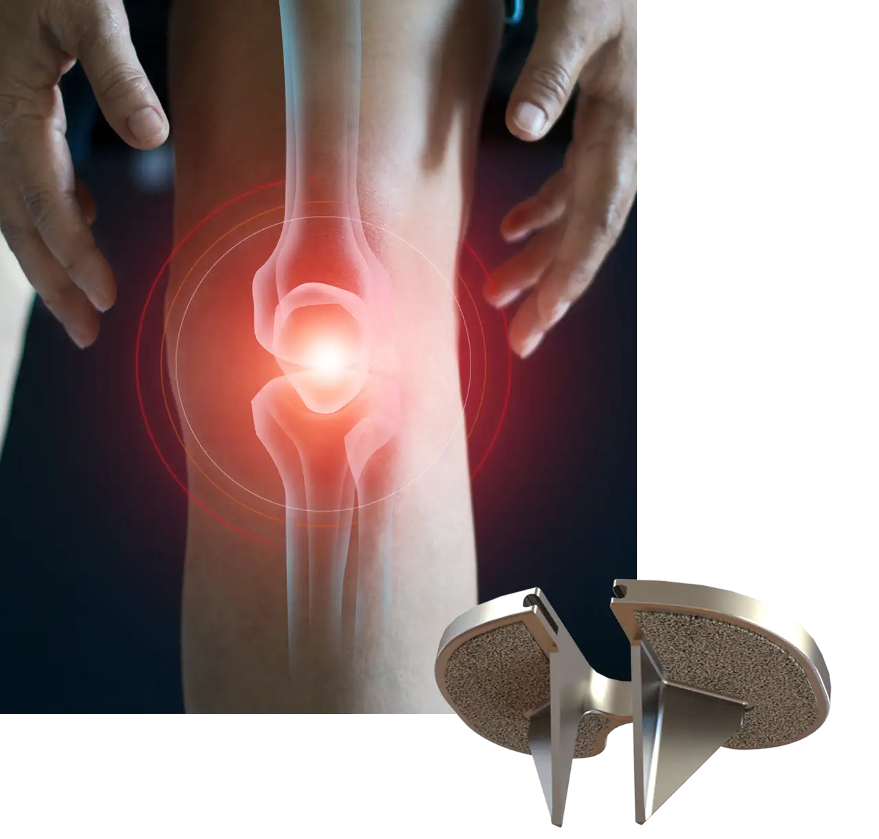 Knee with highlighted joint pain beside an Optimotion total knee implant